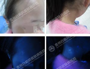 李某-10岁-散在型-进展期白癜风-3年2.jpg