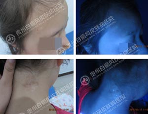 李某-10岁-散在型-进展期白癜风-3年3.jpg
