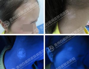 李某-10岁-散在型-进展期白癜风-3年1.jpg