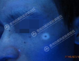 林某-24岁-晕痣型白斑-1个月2.jpg