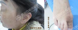 林某-53岁-肢端型-进展期白癜风-2个月4.jpg