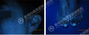 林某-53岁-肢端型-进展期白癜风-2个月2.jpg