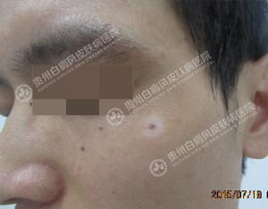 林某-24岁-晕痣型白斑-1个月1.jpg