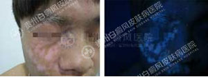 治好白斑.jpg
