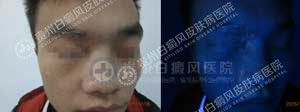 治好白斑1.jpg