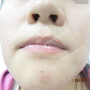 唇周白斑2.jpg