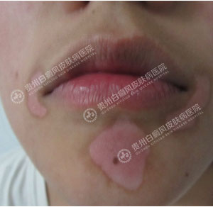 唇周白斑1.jpg