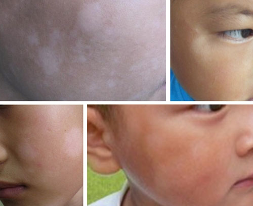 小孩脸上白斑.jpg