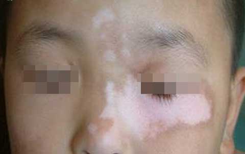 孩子白癜风.jpg